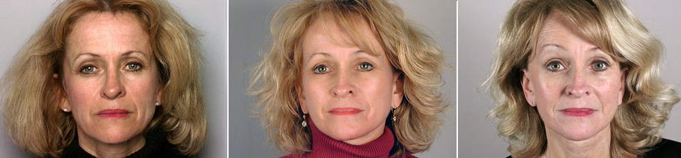 Woman before, after, and years after endoscopic browlift and facelift