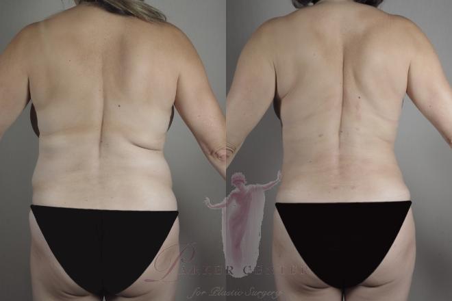 Woman's back before and after BodyTite and liposuction