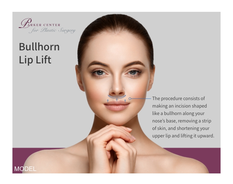 Bullhorn lip lift