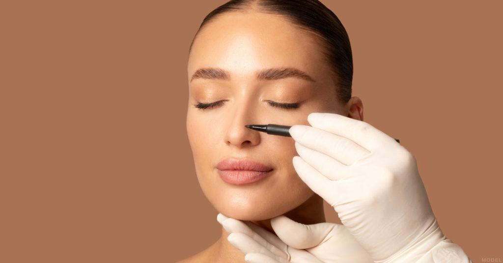 Woman preparing for rhinoplasty with surgical markings on her nose (model).