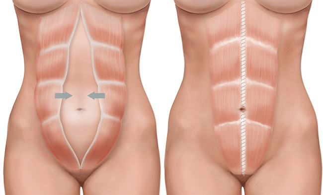 Diastasis Recti (Muscle Repair) diagram
