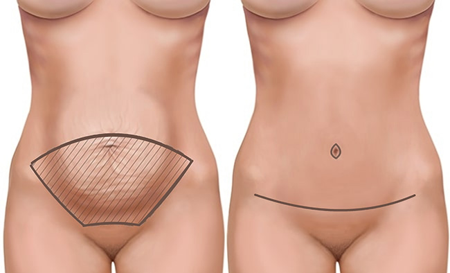 Excess Skin Removal Diagram