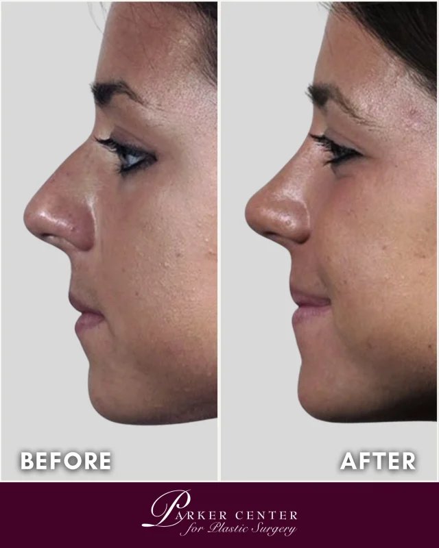 She came in wanting a nose that felt like her.

This rhinoplasty result speaks for itself. A refined profile, improved balance, and a look that feels completely natural because it was designed to complement her features, not change them.

Dr. Parker has spent more than 30 years perfecting results like this one. Every procedure is approached with precision, artistry, and a deep respect for what each patient actually wants.

Ready to explore what rhinoplasty could do for you? Link in bio to schedule your consultation.

📍 Parker Center for Plastic Surgery | Paramus, NJ
📞 201-967-1212

#Rhinoplasty #PlasticSurgery #BeforeAndAfter #ParkerCenterForPlasticSurgery #NewJerseyPlasticSurgery #NaturalResults #RhinoplastyResults #BoardCertifiedSurgeon