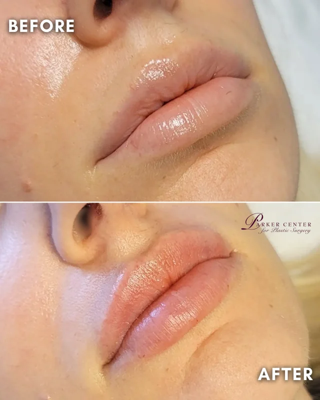 💋 Sometimes the smallest change creates the biggest confidence boost.

Beautiful lips aren't about looking overdone—they're about balance, hydration, and enhancing what you already have.

✨ Improved shape and definition
✨ Enhanced volume where needed
✨ Soft, natural-looking results
✨ Customized to your facial features

This subtle lip filler treatment added fullness while maintaining a natural appearance that complements the patient's features.

📍 Parker Center for Plastic Surgery | Paramus, NJ
📞 201-967-1212

#LipFiller #NaturalLipFiller #LipEnhancement #LipFillerNJ #ParamusNJ #BergenCountyNJ #LipGoals #AestheticMedicine #ParkerCenter #ConfidenceBoost