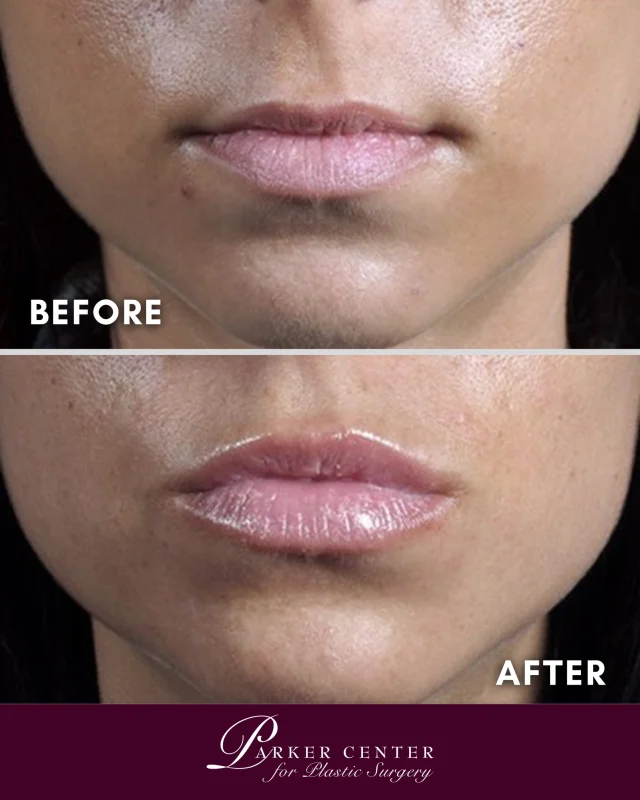 💋 Fuller lips. Natural results.

Beautiful lip filler isn't about looking different—it's about enhancing what's already there.

This patient wanted more fullness in both the upper and lower lips while maintaining a soft, balanced appearance. Using a customized approach, filler was strategically placed to create natural-looking volume, improved definition, and better overall facial harmony.

✨ Fuller upper and lower lips
✨ Enhanced shape and symmetry
✨ Soft, natural-looking volume
✨ Results tailored to the individual

Because the best lip filler results don't announce themselves—they simply make you look refreshed, confident, and beautifully you.

📍 Parker Center for Plastic Surgery | Paramus, NJ
📞 201-967-1212

#LipFiller #NaturalLipFiller #LipEnhancement #DermalFiller #LipGoals #InjectablesNJ #ParamusNJ #BergenCountyNJ #FacialHarmony #NaturalResults