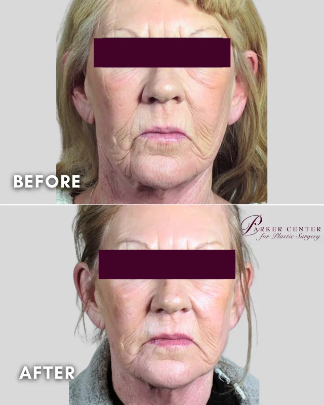✨ Aging is inevitable. Looking tired doesn't have to be.

This patient wanted to address facial wrinkles and skin laxity without surgery.

Angela treated the face and neck with Halo® laser, a powerful resurfacing treatment that stimulates collagen production while improving skin texture, tone, and overall quality.

✨ Softer lines and wrinkles
✨ Firmer, healthier-looking skin
✨ Improved texture and radiance
✨ Natural-looking rejuvenation

The result? A smoother, refreshed appearance that still looks completely like her—just brighter, healthier, and more confident.

She loved her results so much, she came back for another Halo treatment to continue building on her transformation.

📍 Parker Center for Plastic Surgery | Paramus, NJ
📞 201-967-1212

#HaloLaser #LaserResurfacing #SkinRejuvenation #CollagenStimulation #AntiAgingTreatment #HaloLaserNJ #ParamusNJ #BergenCountyNJ #GlowFromWithin #NonSurgicalRejuvenation #ParkerCenterForPlasticSurgery #AngelaParisiParkerRNFNPC