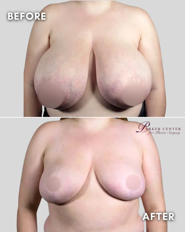 ❤️ Relief is Possible.

For many women, breast reduction isn’t about appearance—it’s about finally feeling comfortable in their own body.

At just 20 years old, this patient had struggled with disproportionately large breasts for years. Everyday activities, exercise, and maintaining a healthy lifestyle had become increasingly difficult.

Dr. Parker performed a breast reduction and lift, removing 1,750 grams from each breast while preserving the nipple's natural blood supply and sensation.

The result?

✨ Less physical burden
✨ Greater comfort and mobility
✨ Easier exercise and weight loss
✨ Renewed confidence

She told Dr. Parker the procedure changed her life—helping her become more active, more confident, and more outgoing.

Sometimes the weight you lose is more than physical.

📍 Parker Center for Plastic Surgery | Paramus, NJ
📞 201-967-1212

#BreastReduction #BreastReductionSurgery #BreastLift #PlasticSurgeryNJ #ParamusNJ #BergenCountyNJ #BreastReductionJourney #LifeChangingResults #DrPaulParker #ParkerCenterForPlasticSurgery