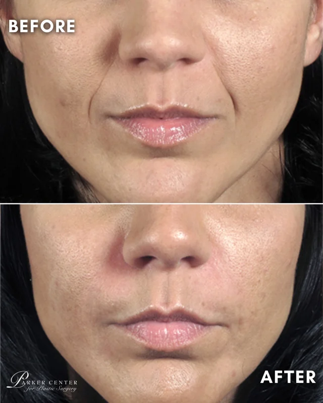 ✨ The best filler is the kind no one notices.

Nasolabial folds can create shadows and heaviness around the mouth, making you look tired even when you feel your best.

With strategic filler placement, we restored volume where it had been lost—softening the folds while maintaining a natural, refreshed appearance.

💉 Smoother smile lines
💉 Restored facial balance
💉 Natural-looking rejuvenation

The goal isn't to look different. It's to look like yourself—just more refreshed.

📍 Parker Center for Plastic Surgery | Paramus, NJ
📞 201-967-1212

#NasolabialFolds #SmileLineFiller #FacialRejuvenation #DermalFiller #NaturalResults #InjectablesNJ #ParamusNJ #BergenCountyNJ #ParkerCenter #AestheticMedicine #LookRefreshedNotDone