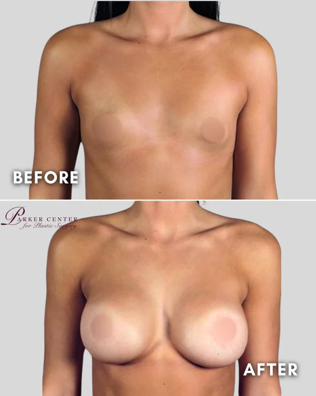 She came to us referred by a patient who trusted us with her own results. That means everything to us.

At 20, she was navigating a complex situation — tuberous breast deformity alongside a rheumatoid arthritis diagnosis that shaped her surgical options. Dr. Parker created a plan tailored to her body, her health, and her goals.

Today she says she feels more confident than ever. That is the whole point.

If you have been told your anatomy is complicated, or that your health history limits your options — come talk to us. There is almost always a path forward.

📍 Parker Center for Plastic Surgery | Paramus, NJ
📞 201-967-1212

#BreastAugmentation #TuberousBreast #TuberousBreastCorrection #BreastImplants #BoardCertifiedPlasticSurgeon
