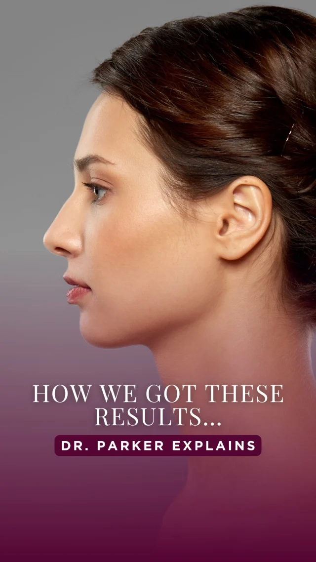 Every rhinoplasty tells a different story. ✨

This 15-year-old patient wanted a nose that felt more balanced with her features while still looking completely like herself. There was no “cookie-cutter” approach—every detail of her surgical plan was customized to complement her unique facial anatomy.

In this video, Dr. Parker breaks down the thought process behind her rhinoplasty, including how subtle refinements to the bridge and nasal tip created a softer, more harmonious profile while preserving a natural appearance.

The goal of rhinoplasty isn’t to create a new face—it’s to enhance your natural features with results that stand the test of time.

Thinking about rhinoplasty? Schedule a consultation to learn what a personalized surgical plan could look like for you. Call us or send us a DM to get started. ✨

#Rhinoplasty #NoseJob #NaturalResults #PlasticSurgery #njplasticsurgeon