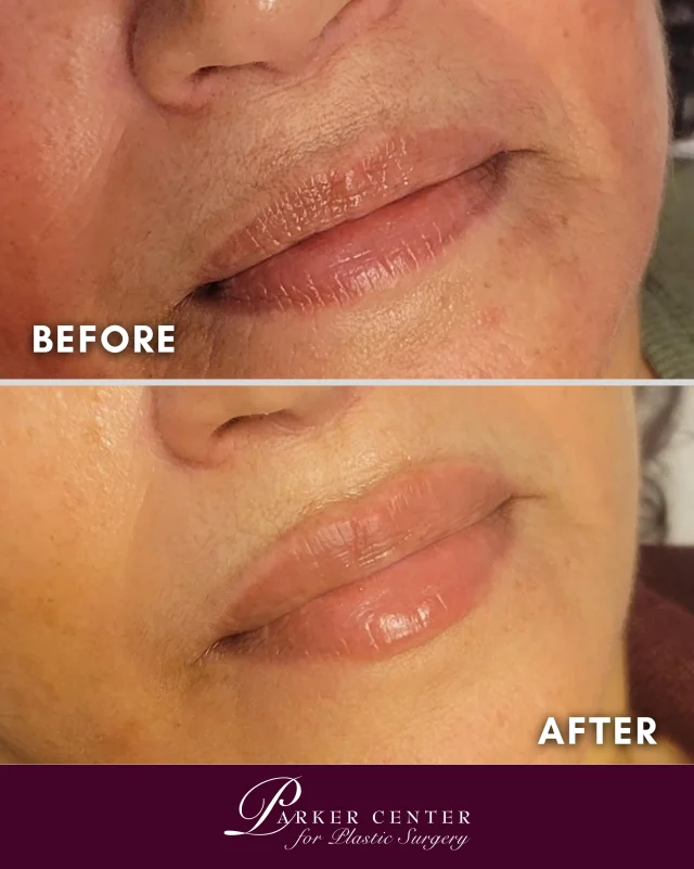 ✨ Subtle enhancement. Beautiful balance. ✨

A little volume can make a big difference. This lip filler treatment enhanced the natural shape, improved hydration, and restored soft, balanced definition—without looking overdone.

Because the best lip filler doesn’t change your lips… it simply enhances what you already have.

💋 Schedule your consultation at Parker Center for Plastic Surgery.

#LipFiller #NaturalLipFiller #LipEnhancement #DermalFiller #ParkerCenter PlasticSurgery MedSpa BeforeAndAfter NaturalResults ParamusNJ