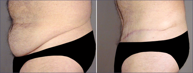 Male Liposuction Before and After Photo