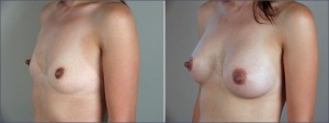 breast augmentation new jersey